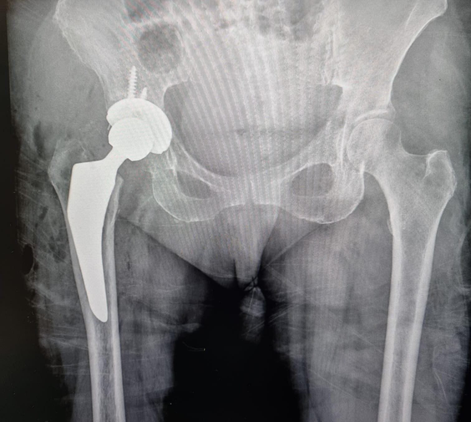 Imagen de cirugia-de-sustitucion-articular-en-cdmx.jpg