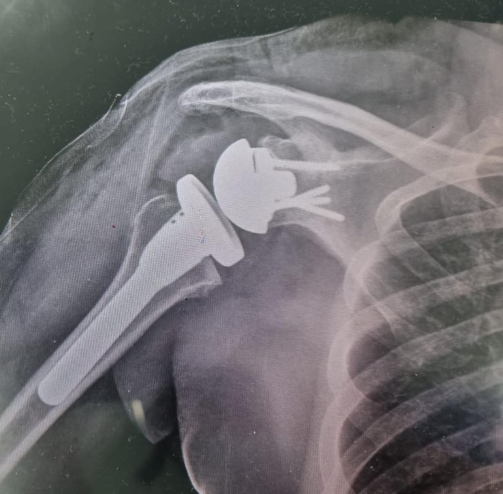 Imagen de protesis-de-rodilla-en-cdmx.jpg