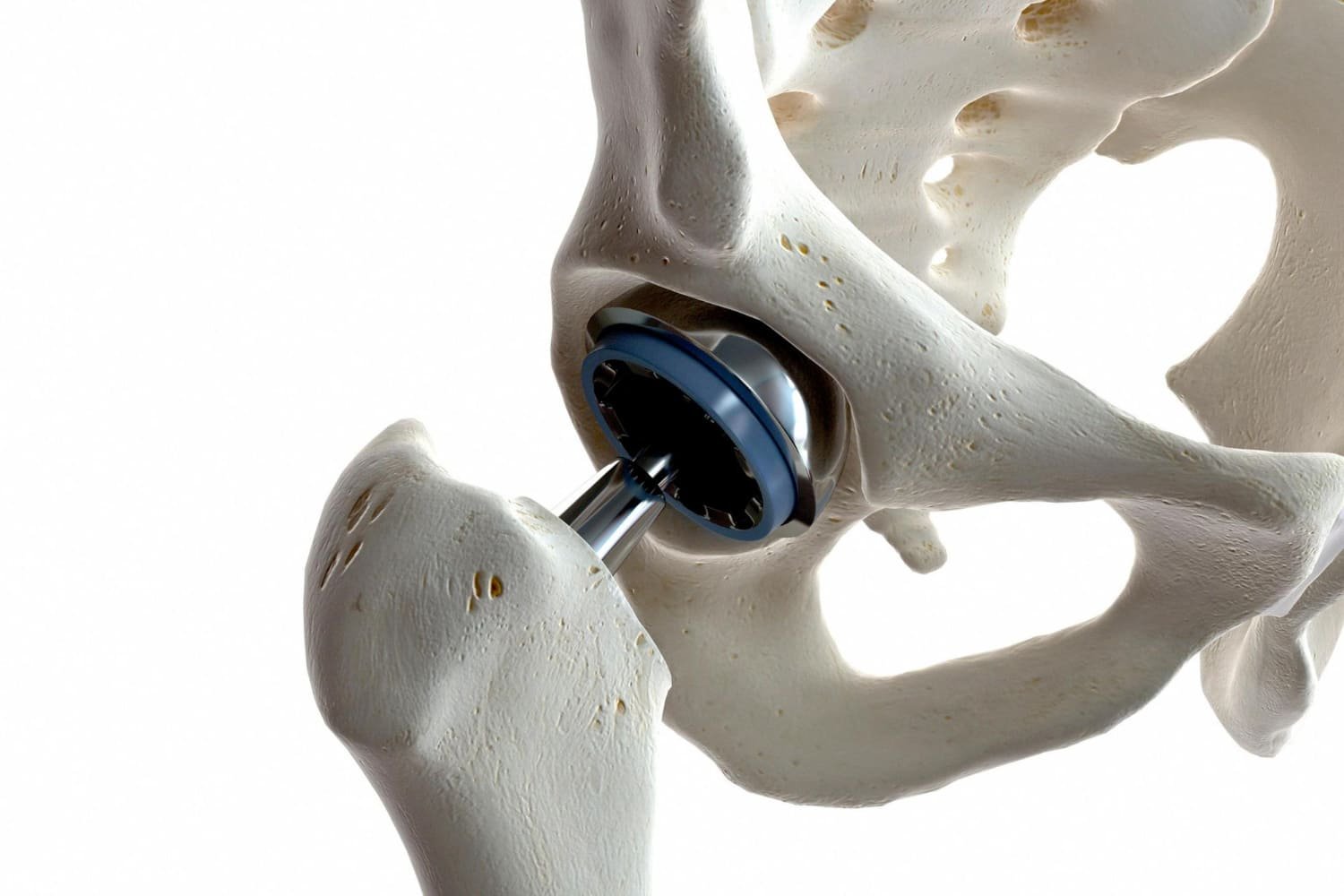 Cirugía de sustitución compleja de articulación (hombro, cadera, rodilla, tobillo)